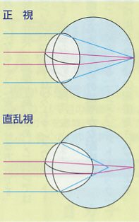 正視と乱視